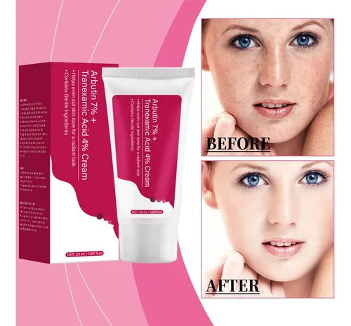 Crema Facial Tranexamic Para Tratamiento De Hiperpigmentació