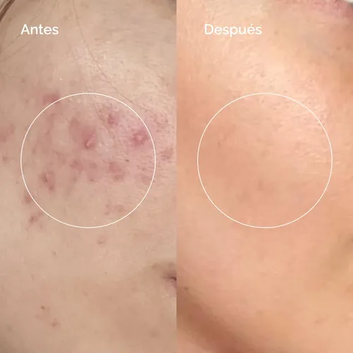 Pack X2 Locion Acido Salicilico 2% Cloe Tratamiento Acne
