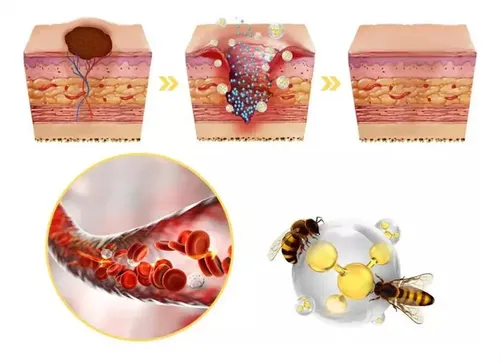 Zspray Para Verrugas Con Veneno De Abeja Para Reparar La Pie