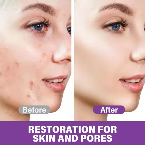 Crema De Ácido Azelaico, Esencia Facial De Ácido