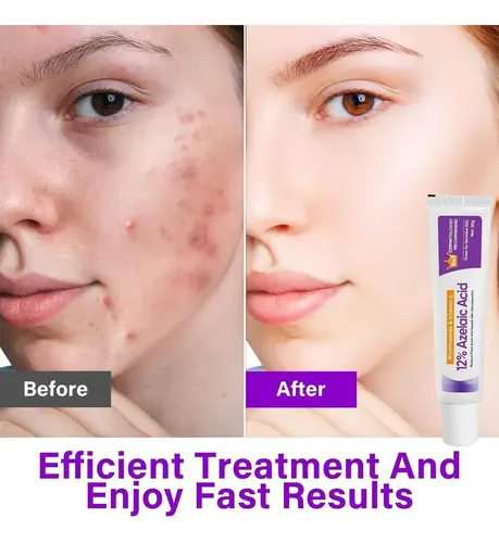 Mf3  Crema Con Ácido Azelaico Al 12% La Esencia Azelaica C X