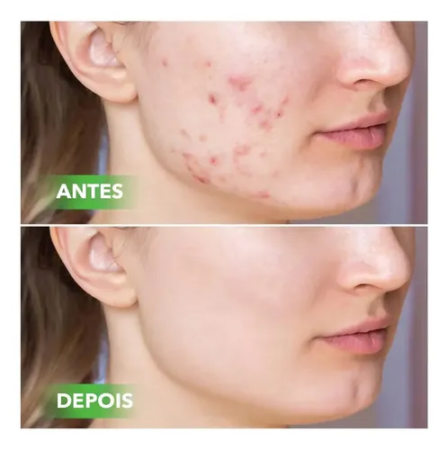 / Crema De Ácido Salicílico Para Eliminar Los Poros Del