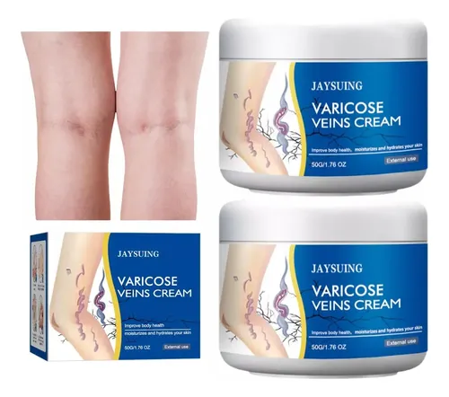 Sd1tratamiento For Las Varices En Las Piernas2026