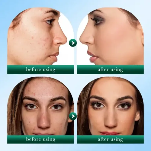 Limpiador Facial Control de Acné y Grasa con Árbol de Té de 100 ml Sadoer