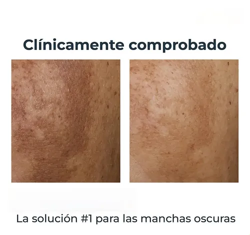 Crema Corporal Para La Eliminación Local De Mz25