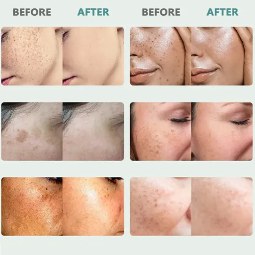 C Elimina Las Manchas Faciales: Melasma, Pecas, Qcc
