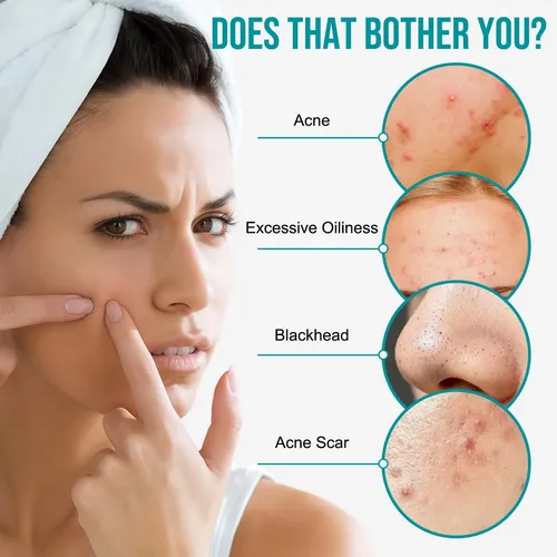 $crema Facial Antiacné 20 G, Hidratante, Reduce Los Granos D