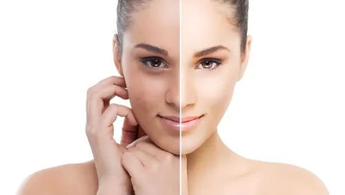 Idraet Mascara Peeling Enzimatica Nutritiva Blanqueadora