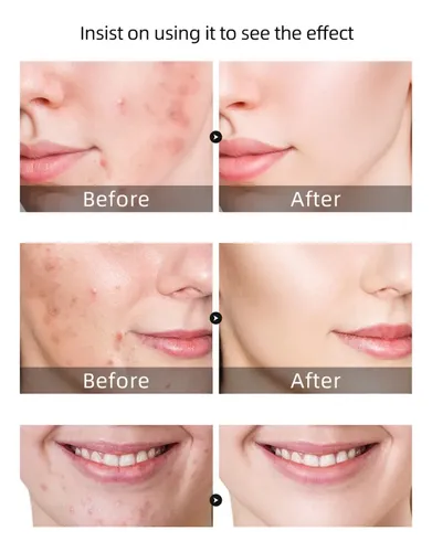 Gel Antiacné Reparador Calmante Hidratante 30 G Todo Tipo De Piel Día/noche