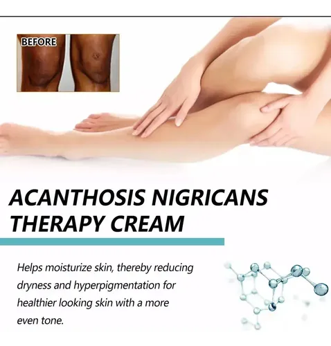 D Fixderma Nigrifix Crema Para Acantosis Nigricans Fbgxx