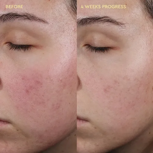 Crema Hidratante Byoma Blemish 50 Ml Acne Control