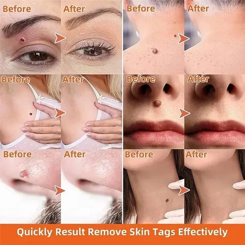 Crema Para La Eliminación Instantánea De Manchas Removedor
