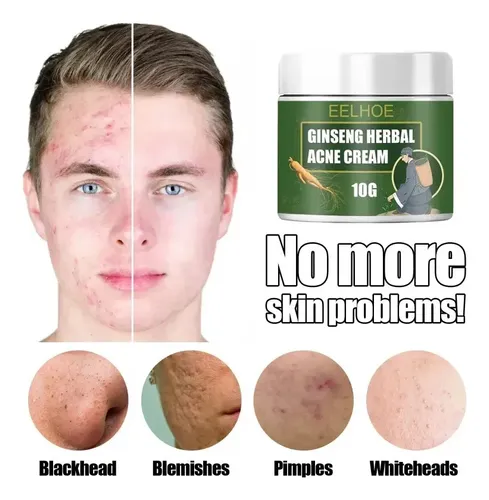 Crema Para El Acné Con Ginseng, 50 G – Oil Control,;