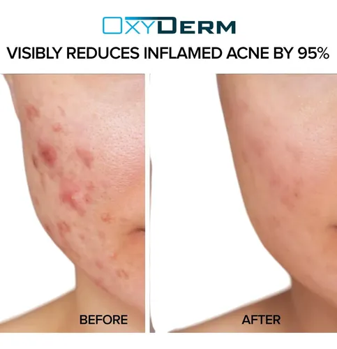 Mascarilla De Arcilla Con Azufre Para Acné, Limpieza