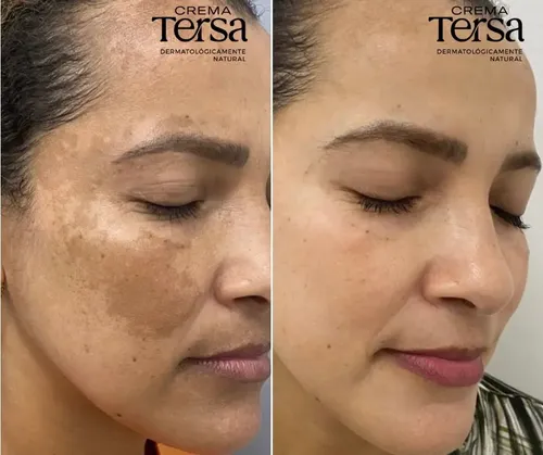 Mzcrema Tersa Despigmentante Quita Manchas Acné Paño De 40gm