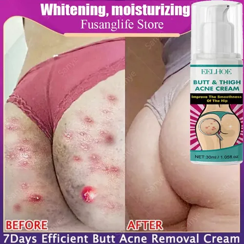 Crema For El Acné, Limpieza De Manchas Oscuras, Espinillas –