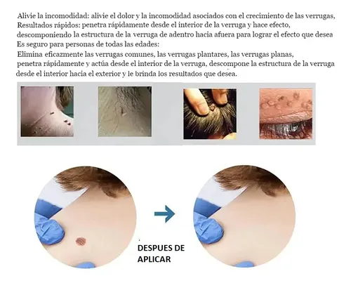 Crema para Eliminar Verrugas del Cuerpo con Propóleo y Fórmula Natural de 10 mL