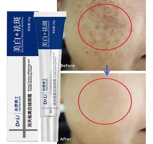 Crema Blanqueadora De Melasma Para Una Eliminación Eficaz