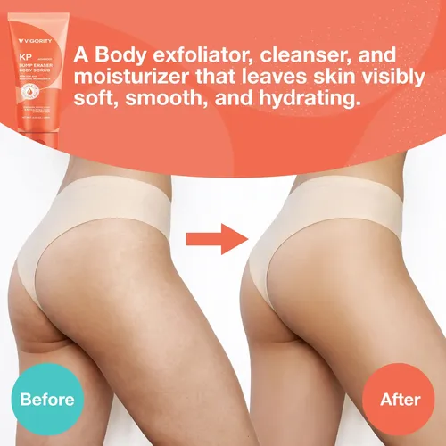 Exfoliante Corporal Vigority Kp Bump Eraser Con 10% De Aha