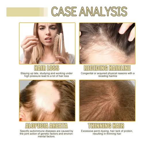 Lael Aceite Esencial De Romero De Eelhoe Para Cabello *****