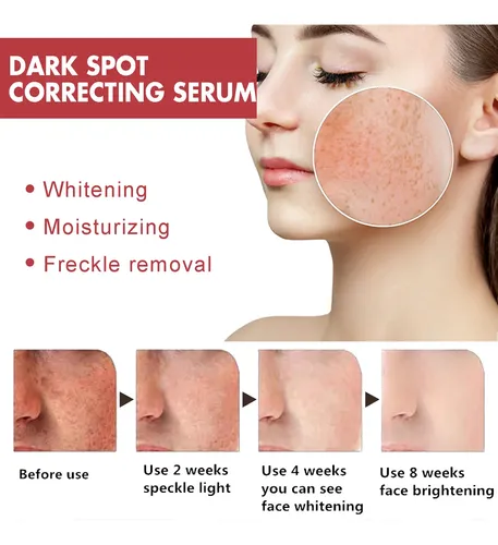 Sérum Corrector De Manchas Oscuras Hoygi Para Melasma Facial