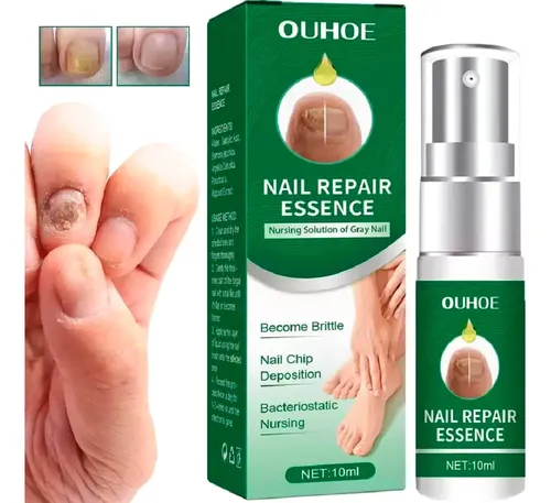 Tratamiento Uñas Hongos Piel Seca Picazón Natural Micosis