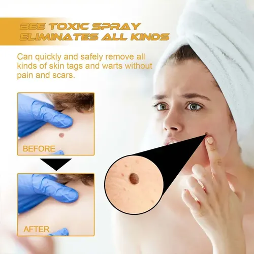 Gel De Crema Removedor De Verrugas Para Rostro Y Cuerpo, 3