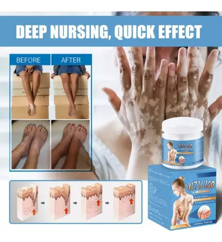 * Para Crema Para Vitíligo, Elimina Las Manchas Blancas