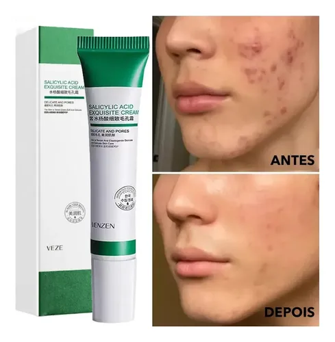.sa Crema De Ácido Salicílico Z Para Eliminar Los Poros .hg
