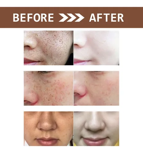 Crema Blanqueadora Hidratante For Aclarar Las Manchas