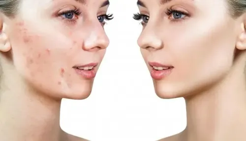 Idraet Acno Sos Acne Imperfecciones Lapiz Secativo Color
