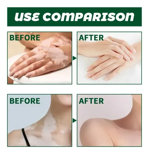 Cjw Tn 3 × Pomada Localizada Creme Vitiligo Branco M Para