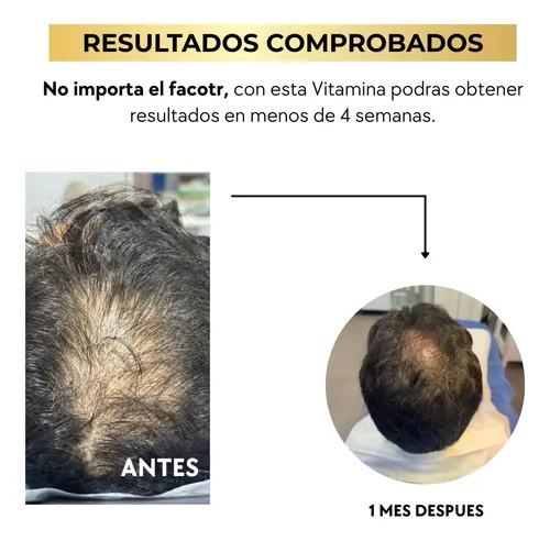 Biotina Capilar X500 Cc, Fortalece Y Acelera El Crecimiento