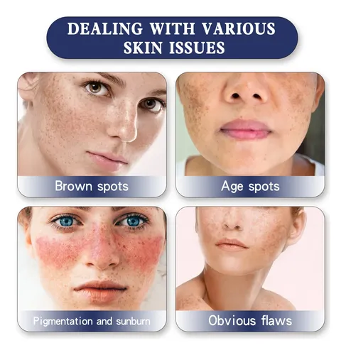 Hy/ Crema Iluminadora Para Decolorar Manchas Hoygi