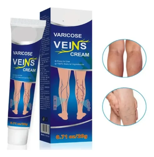 Crema Para Alivio De Varices Piernas Varicosas