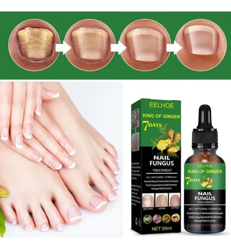 Suero Para Hongos En Las Uñas Para El Tratamiento De Uñaspd