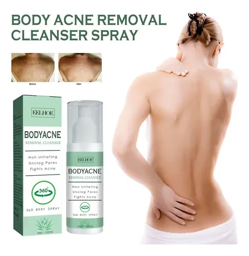 3×spray For Eliminar El Acné Corporal For Espalda, Cuello .