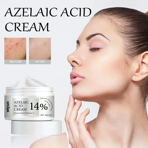 La Crema De Tratamiento Para El Acné Wiyun Limpia E Hidrata  Todo Tipo De Piel