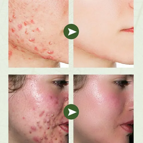 Crema Antiacné Herbal Joyprettyin 50 G Todo Tipo De Piel