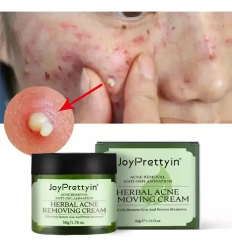Crema For El Acné Del Árbol Del Té Crema Antiacné