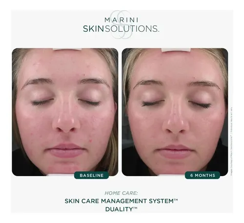 Marini Skinsolutions Duality – Peróxido De Benzoilo Al 10% P