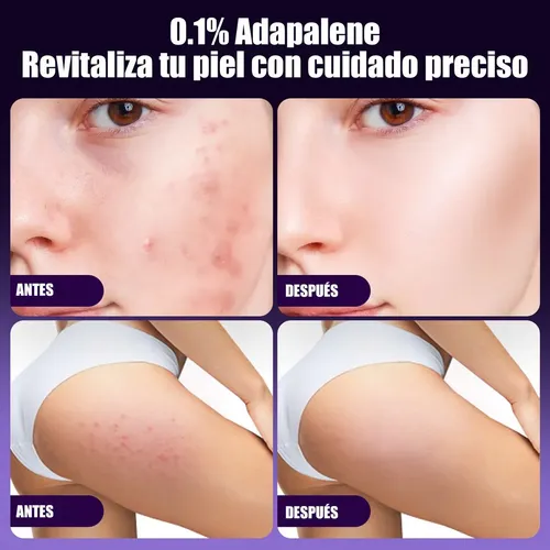 El Antiacné Facial Contiene Adapaleno Para Pieles Con Acné Z