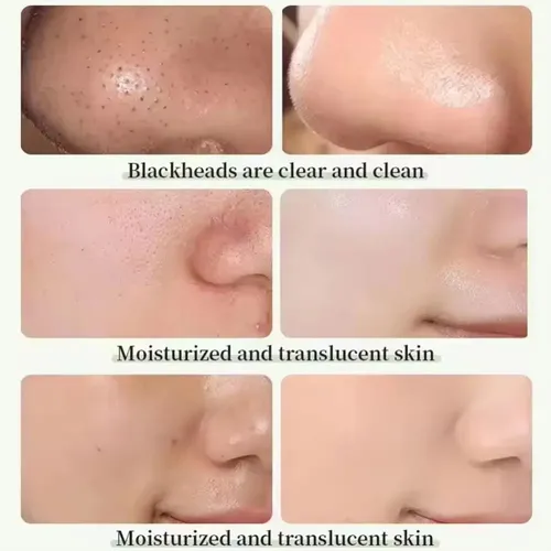 Barra De Arcilla 4 Pzas Para Rostro, Mascarilla Y Acné