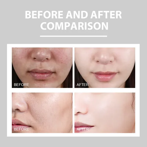 Crema Facial Hidratante Eelhoe Para Rojeces E Imperfecciones