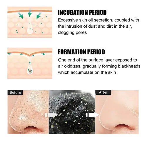 Blackhead Remover Spots Mask Acne Treatment Nose  Ii No