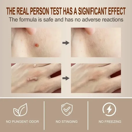 Pack 2 Gel Eliminador Verrugas Acción Rápida Manos Cuerpo