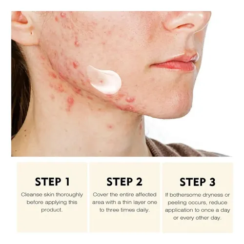 Crema Facial Antiacné Apta Para Todo Tipo De Piel Sensible.