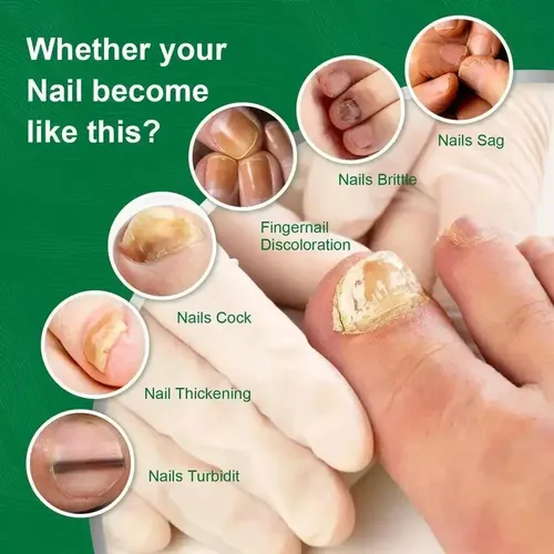 Suero Reparacion Uñas Ataca Hongos Onicomicosis 100% Calidad