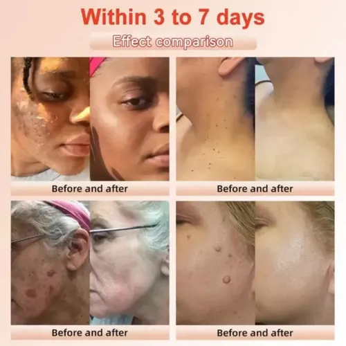 Quarxeripurificante Exfoliante, Gel Exfoliante Avanzado 2 P