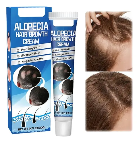 Crema Anticaída Alopecia Areata Bloqueador De Dht Natural